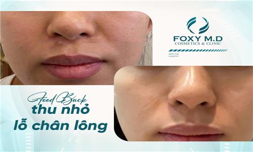 Feedback thu nhỏ lỗ chân lông – Trải nghiệm thực tế cho làn da mịn màng