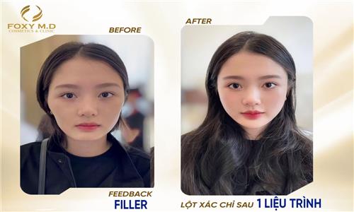 Feedback filler tại Foxy – Hiệu quả thật, đẹp tự nhiên, không cần filter