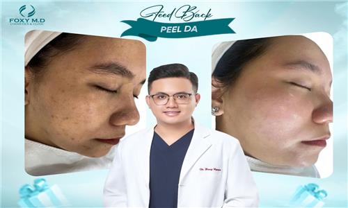 Feedback peel da – Trải nghiệm thực tế và đánh giá chi tiết