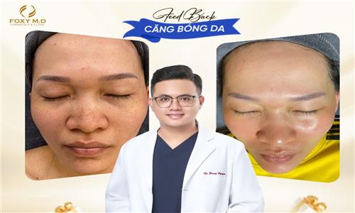 Căng bóng da tại Foxy – Bí quyết làn da chuẩn sương Hàn Quốc