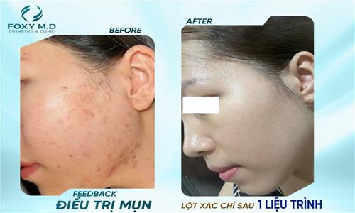 Feedback điều trị mụn – Hành trình thay đổi làn da từng bước một