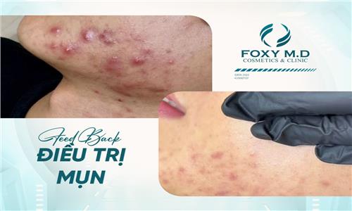 Feedback điều trị mụn – Trải nghiệm thật, kết quả thật