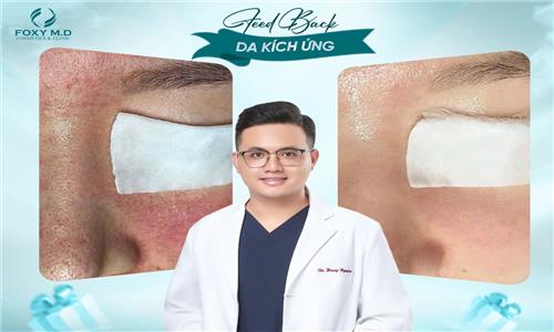 Feedback da kích ứng – Chia sẻ thật từ trải nghiệm thật