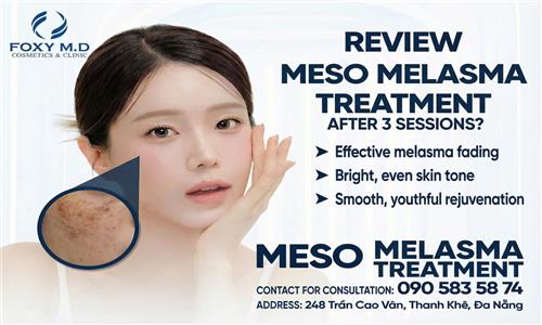 Review of Meso Treatment for Melasma After 3 Sessions: Real Results and What You Need to Know