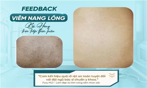 Viêm nang lông – Nguyên nhân, cách điều trị và phòng ngừa tái phát