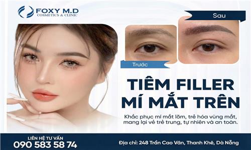 Tiêm filler mí mắt trên: Giải pháp trẻ hóa vùng mắt tự nhiên
