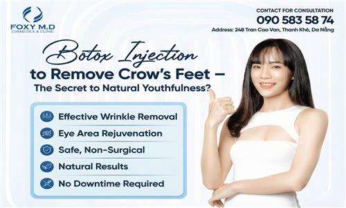 Botox injections for crow's feet - The secret to natural youthfulness