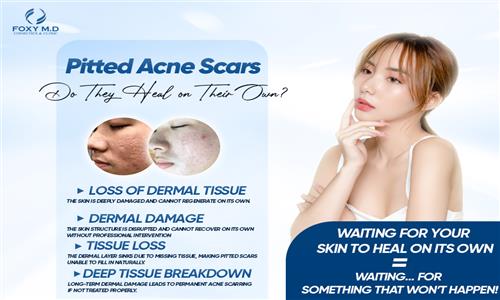 Do Pitted Acne Scars Heal on Their Own? Medical-Standard Treatment Solutions at Foxy MD