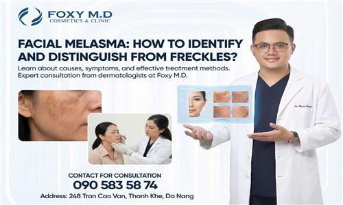 Facial Melasma: How to Identify and Differentiate It from Freckles