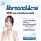 HORMONAL ACNE ON THE CHIN: RECOGNITION AND MEDICALLY STANDARDIZED SOLUTIONS IN DA NANG