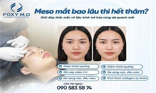 Meso Mắt Bao Lâu Thì Hết Thâm Đà Nẵng? Giải Đáp Từ Chuyên Gia