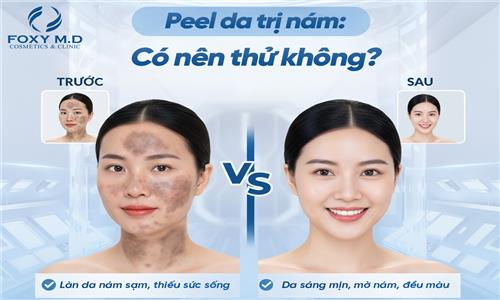 Peel Da Trị Nám Có Nên Thử Không? Lời Khuyên Gan Ruột Từ Chuyên Gia