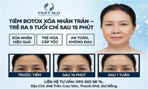 Tiêm botox xóa nhăn trán trẻ ra 5 tuổi chỉ sau 15 phút?