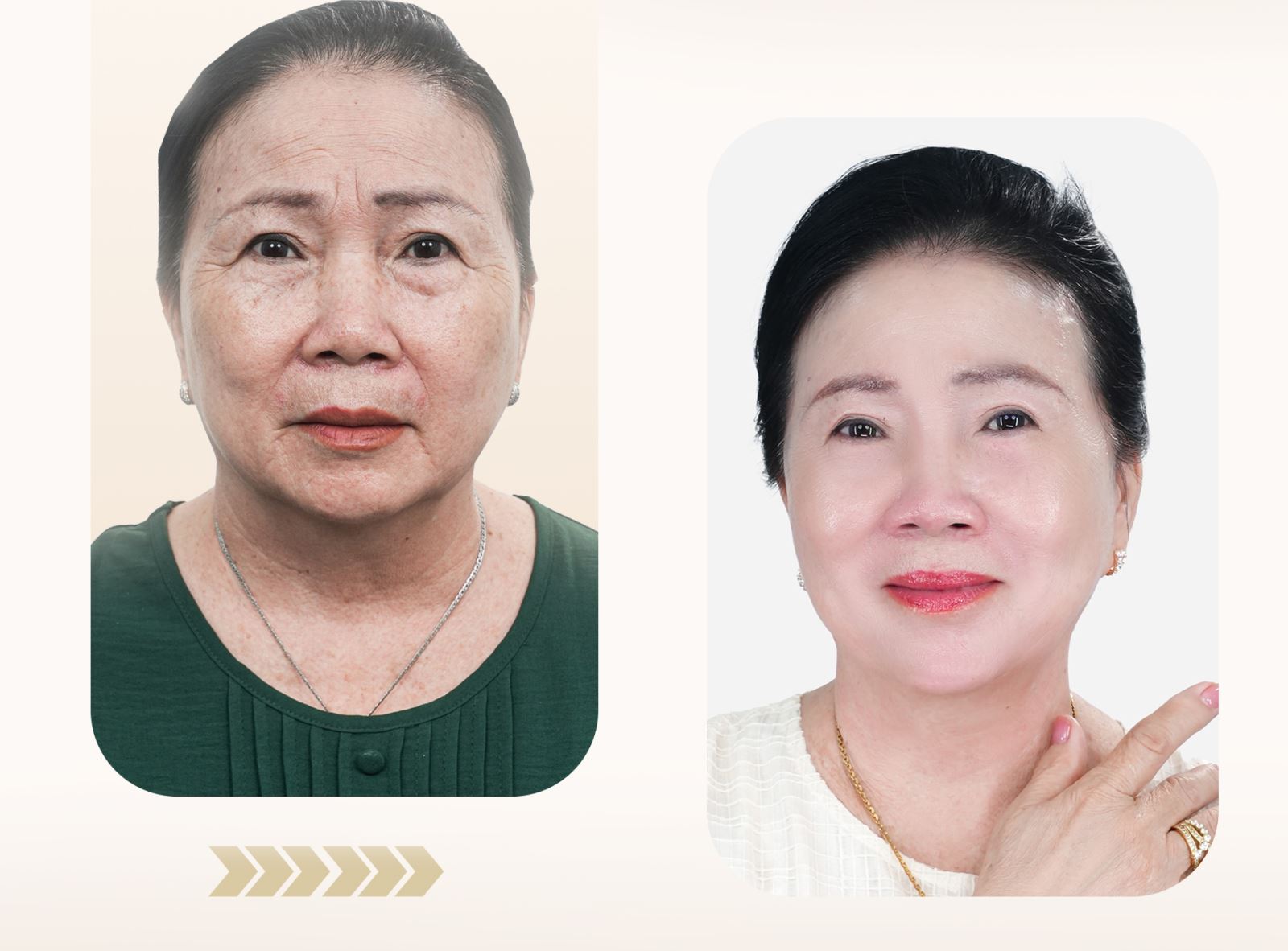 Feedback trị nám tại phòng khám da liễu Foxy có tốt không?
