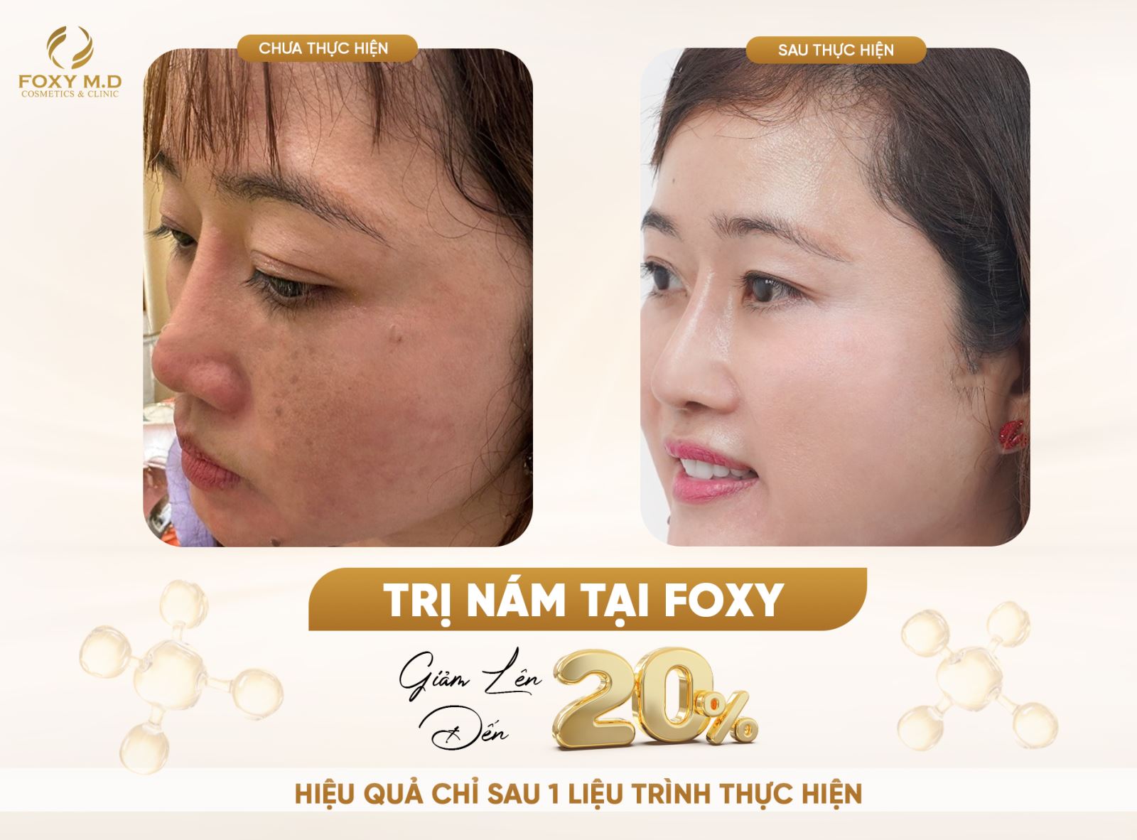 Điều trị nám tại Foxy: Giải pháp an toàn và hiệu quả cho làn da sáng mịn