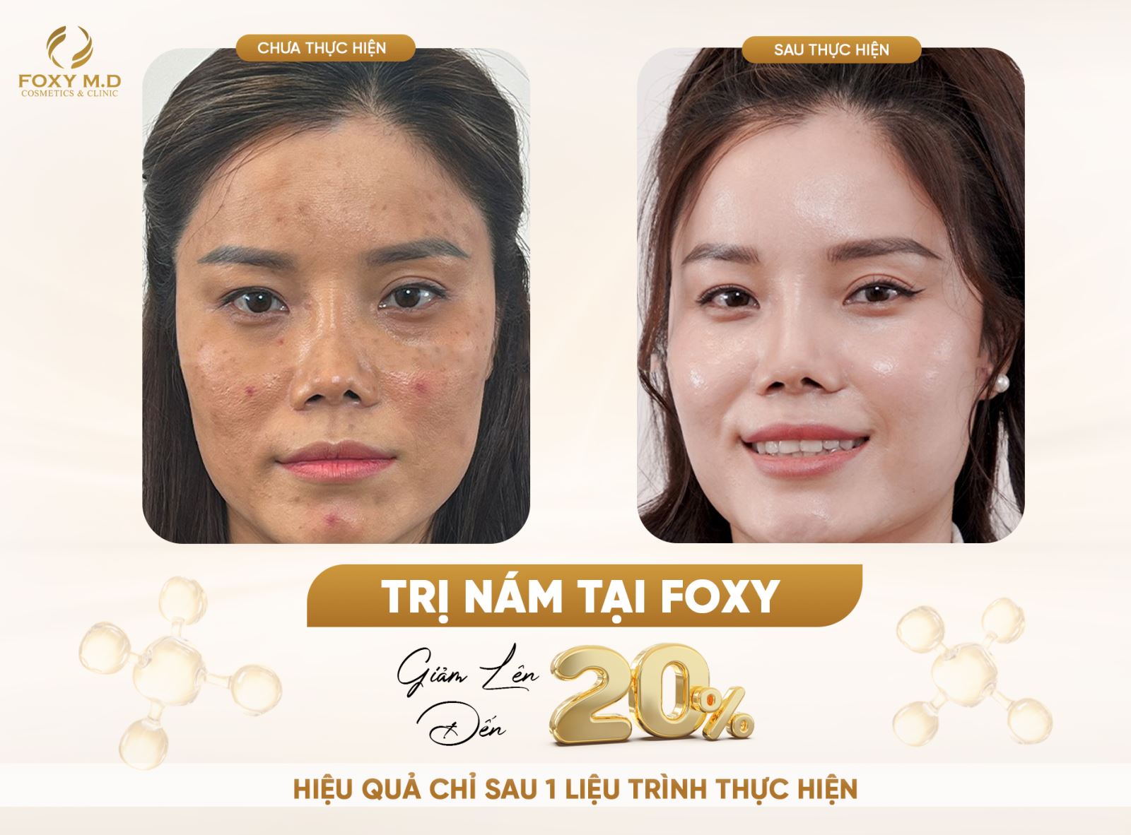 Feedback điều trị nám bởi bác sĩ Hưng: Hiệu quả và uy tín