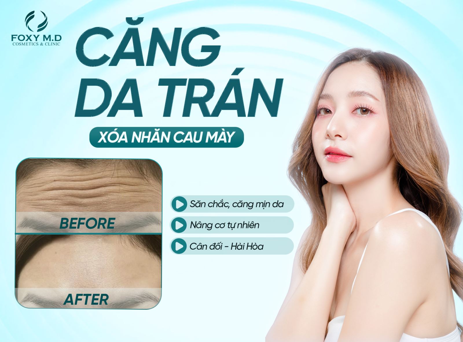 Căng da trán xóa nhăn cau mày – Feedback thực tế với căng chỉ collagen & botox
