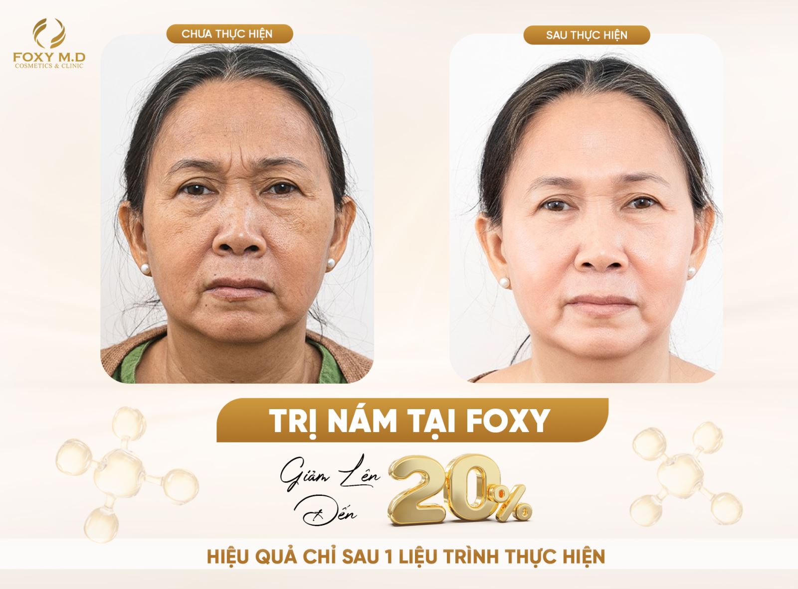 Điều trị nám tại Foxy: Trải nghiệm thực tế và hiệu quả vượt trội Mô tả SEO: