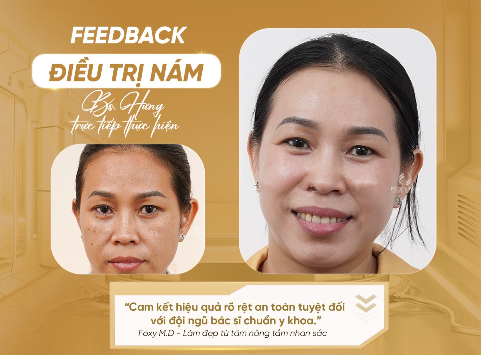 Điều trị nám tại Foxy: Trải nghiệm thực tế và hiệu quả vượt trội