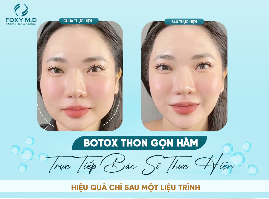 Botox thon gọn hàm: Giải pháp an toàn để có gương mặt V-line tự nhiên