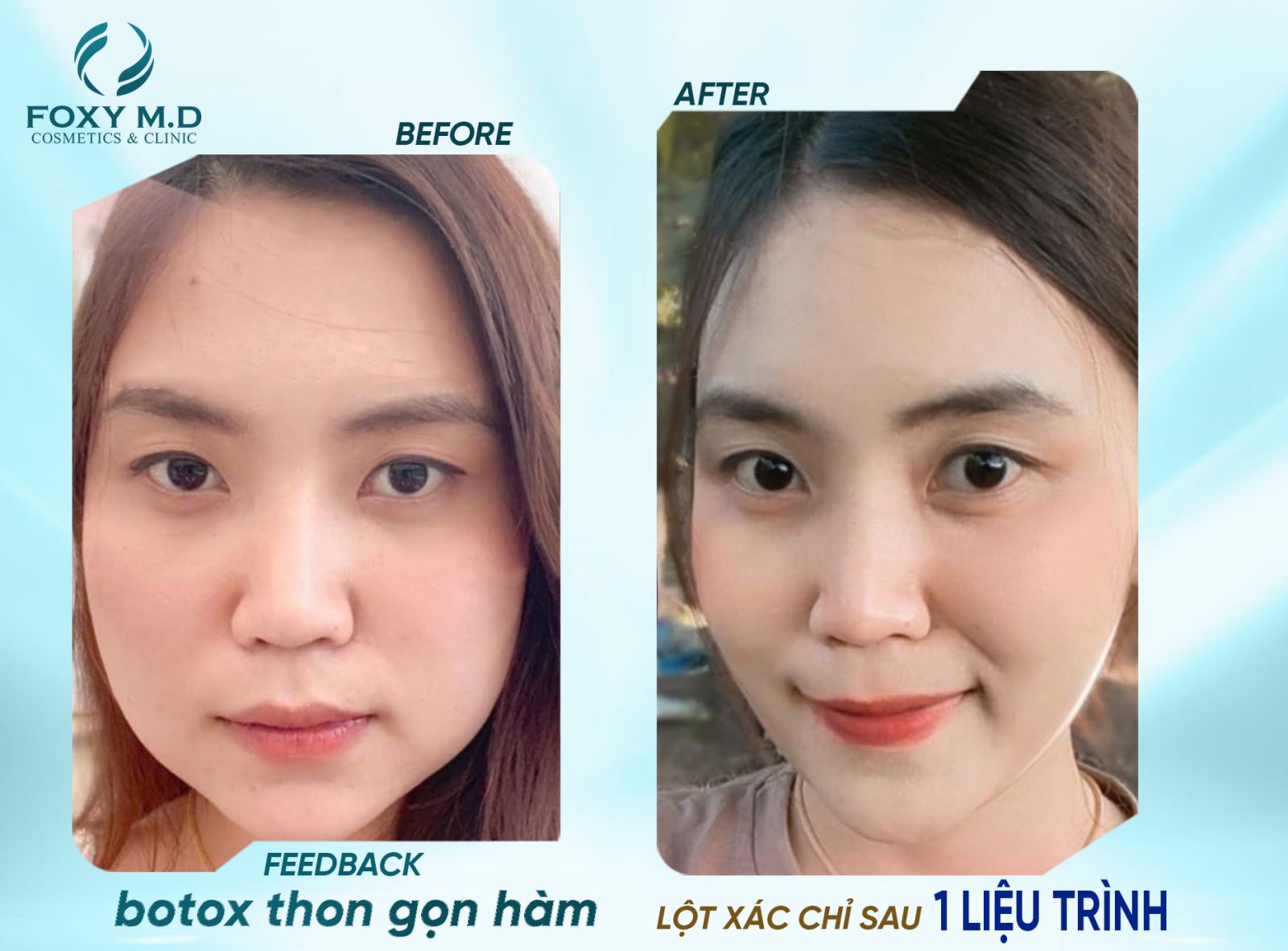 Botox thon gọn hàm – Giải pháp an toàn cho gương mặt V-line tự nhiên