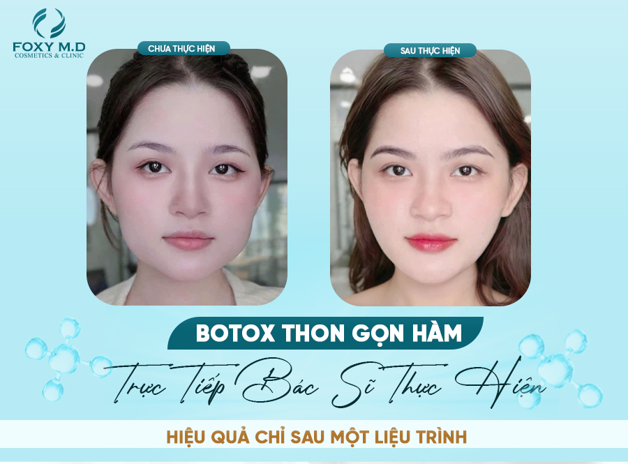 Botox thon gọn hàm – Giải pháp trẻ trung, tự tin cho gương mặt V-line