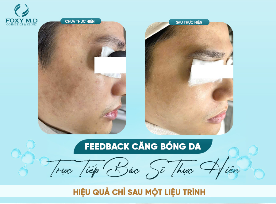 Căng bóng da – Bí quyết trẻ hóa làn da được nhiều người lựa chọn