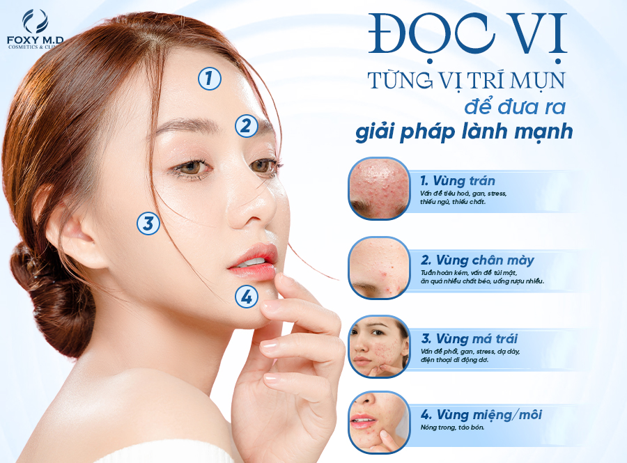 Đọc vị từng vị trí mụn để đưa ra giải pháp lành mạnh