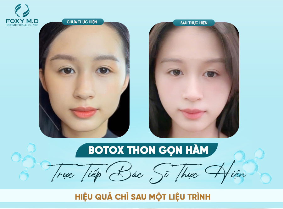 Botox thon gọn hàm – Giải pháp an toàn cho gương mặt V-line tự nhiên