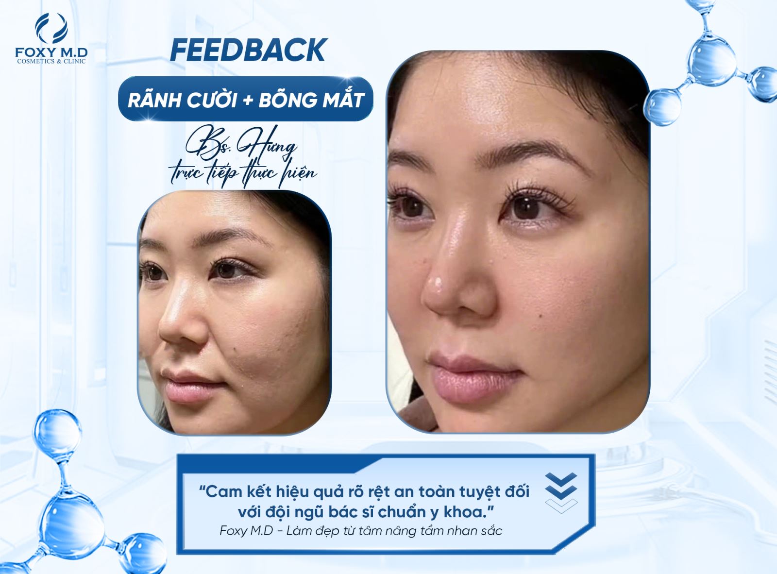 Feedback rãnh cười bọng mắt – Giải pháp trẻ hóa tự nhiên và hiệu quả