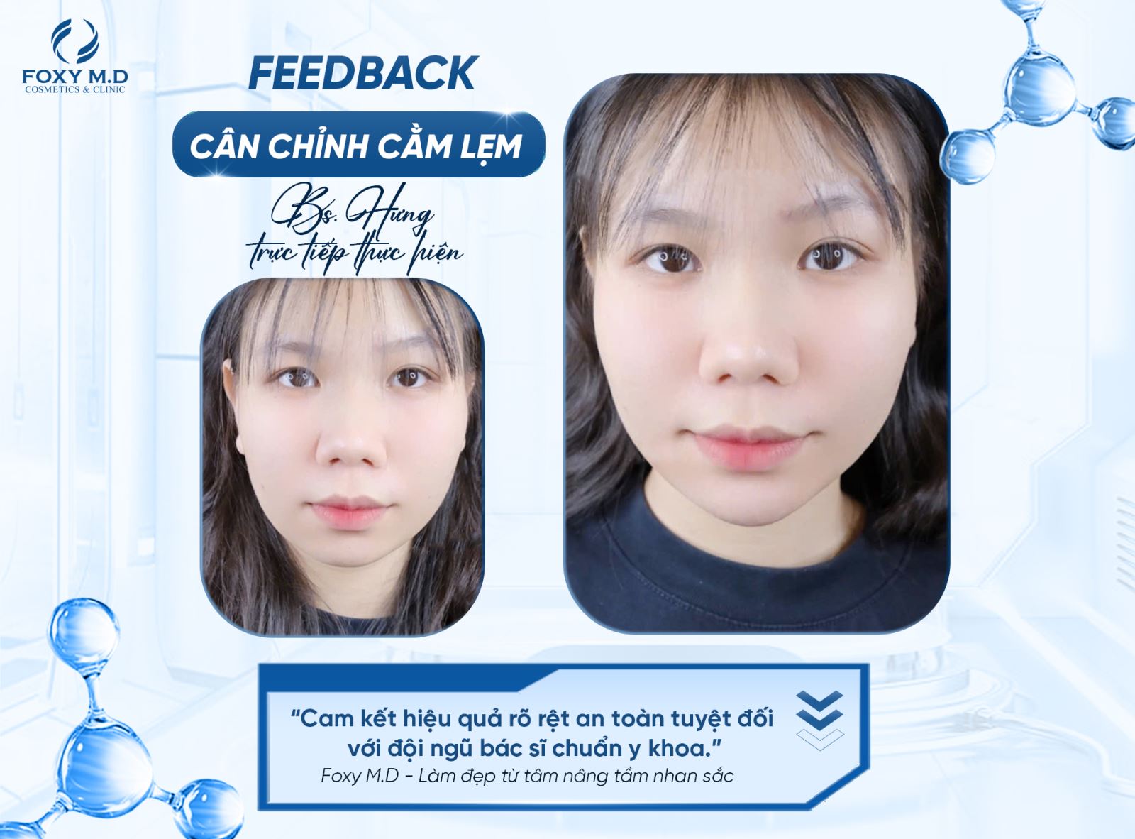 Feedback cân chỉnh cằm lẹm – Review chân thực từ khách hàng