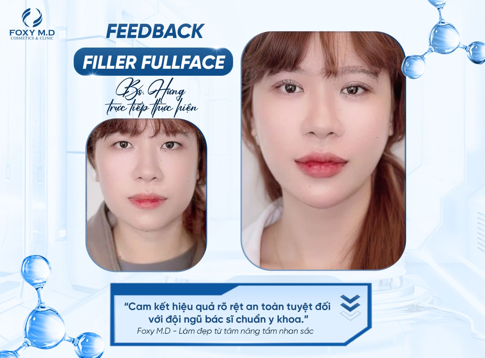 Filler Fullface – Bí quyết trẻ hóa gương mặt toàn diện