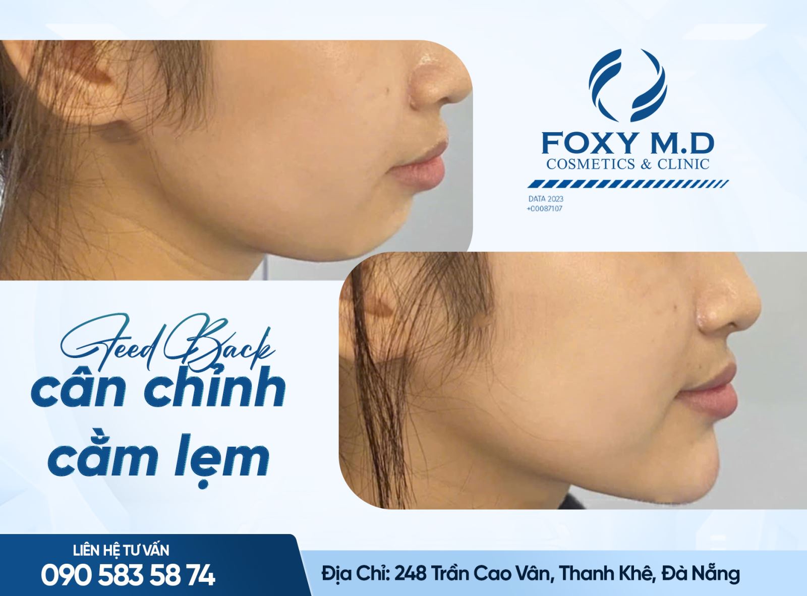 Cân chỉnh cằm lẹm – Giải pháp thẩm mỹ giúp gương mặt hài hòa