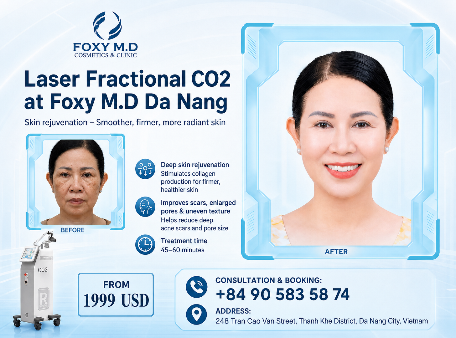 Fractional CO2 Laser in Da Nang — Deep Acne Scar, Enlarged Pore & Wrinkle Treatment at Foxy M.D Clinic