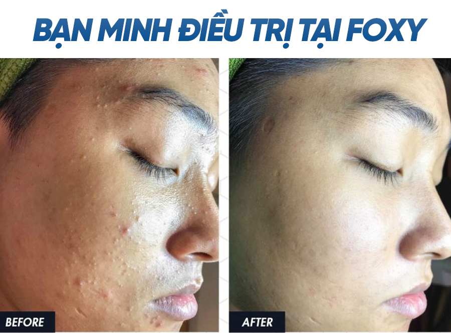 dieu tri mun tại foxy